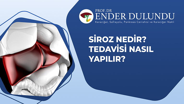 Siroz nedir? Tedavisi nasıl yapılır? 